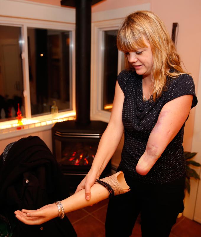 DAN LITTLE Maggie Baumer removes her prosthetic arm after eating dinner Thursday night in Florence. - DAN LITTLE | DAN LITTLE

